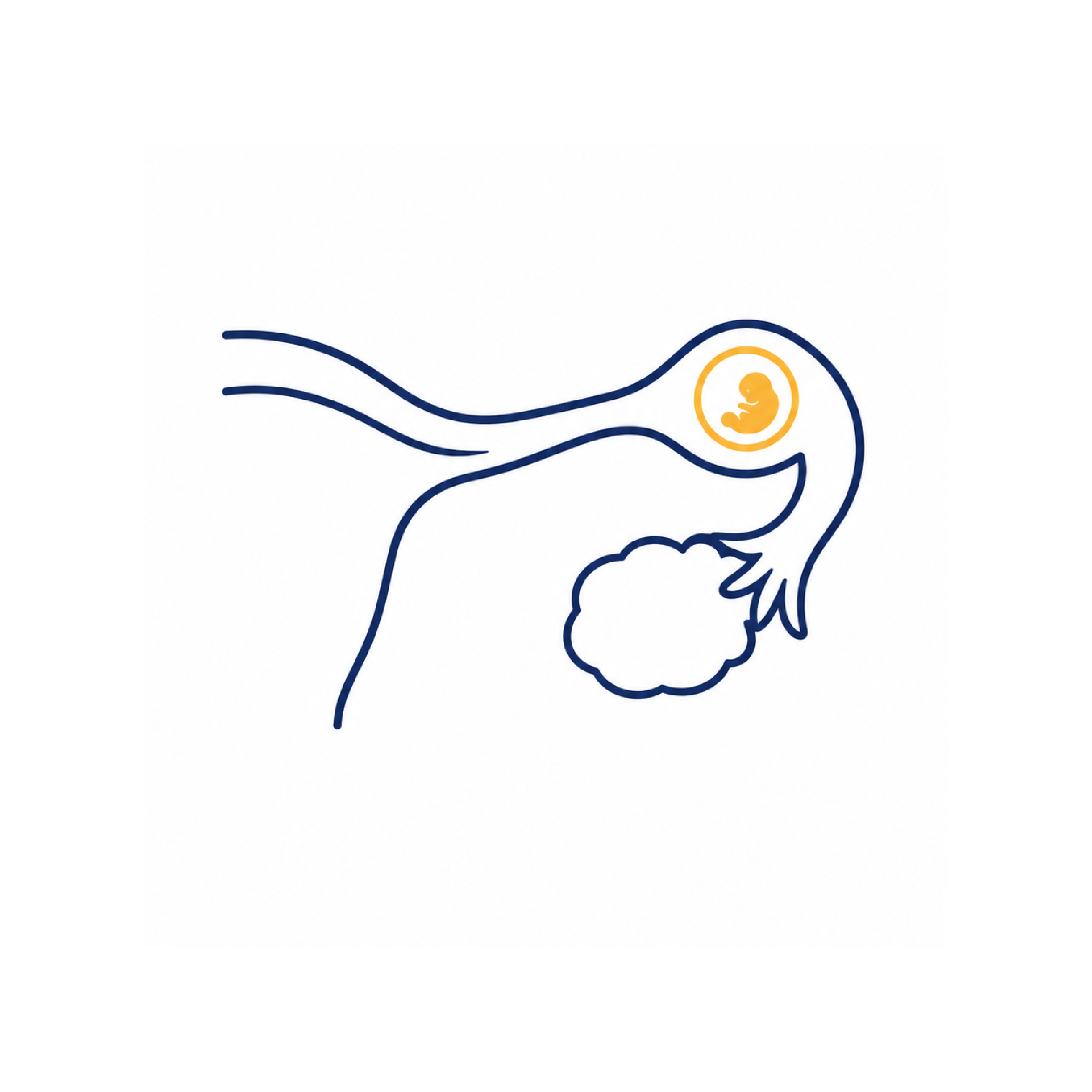 Ectopic Pregnancy